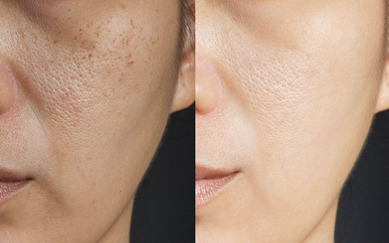 قبل وبعد علاج المسام المتوسعة بالليزر جوليت