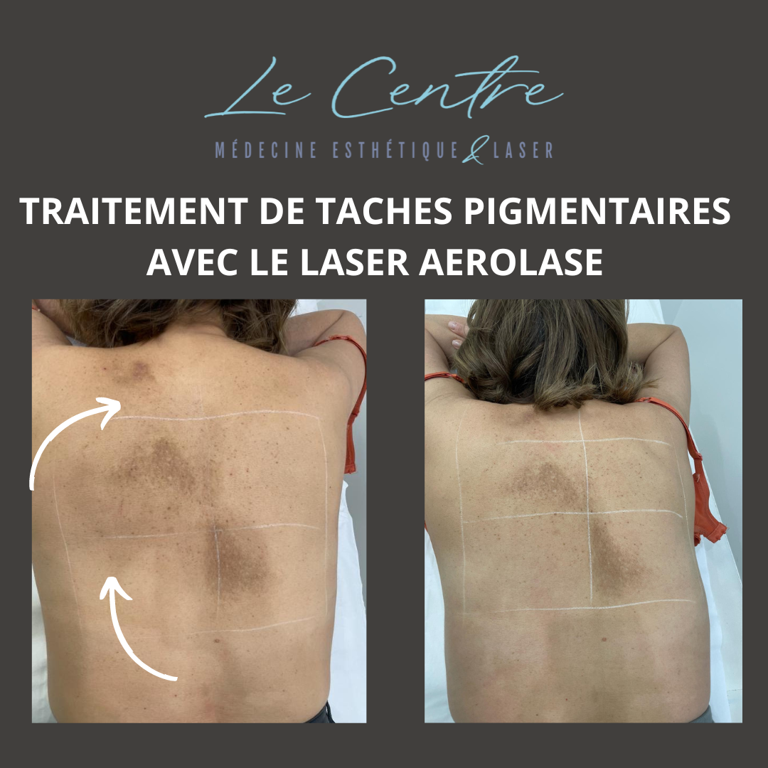 ليزر-أيرولايس