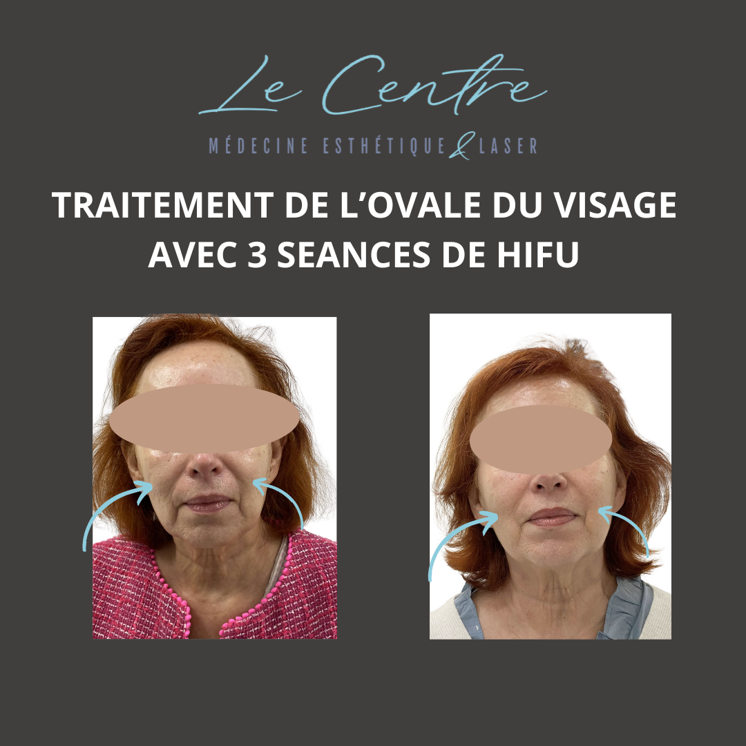 hifu-avant-apres