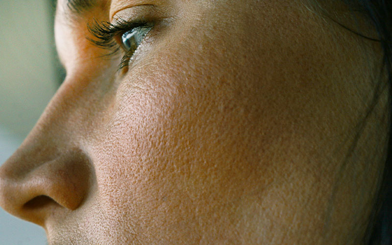 مسام متوسعة في منطقة الوجه