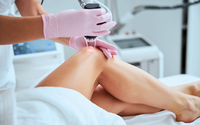 激光治疗腿部静脉曲张