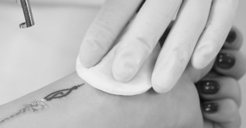 detatouage laser paris