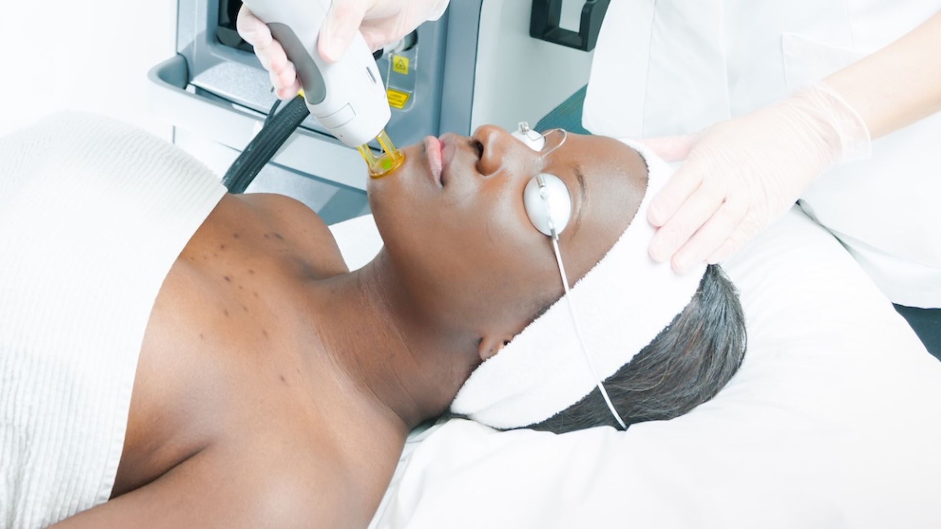 Epilation laser du Visage